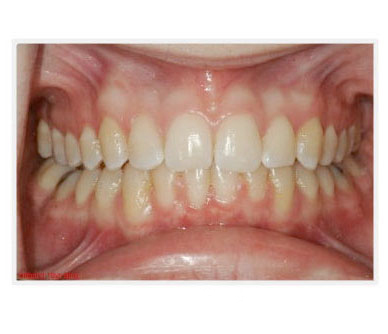 js after before teeth image