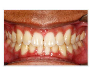 ml after before teeth image