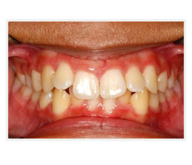 ml before teeth image