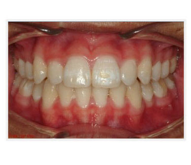 vc after before teeth image
