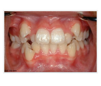 VC before teeth image